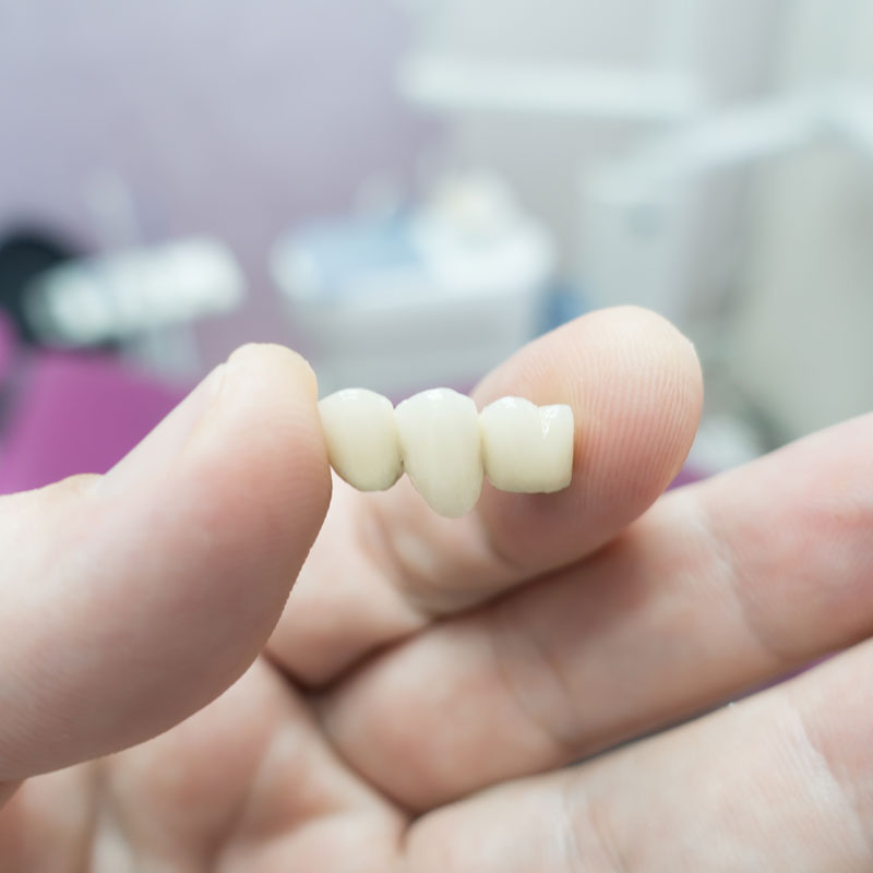 dental bridge