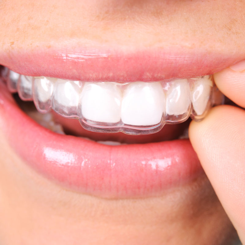 people smiling with invisalign